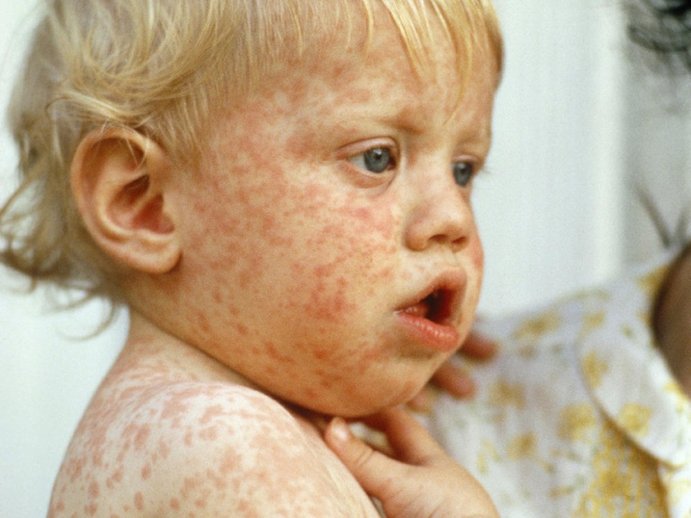 Аллергия на коже можно купаться thumbnail