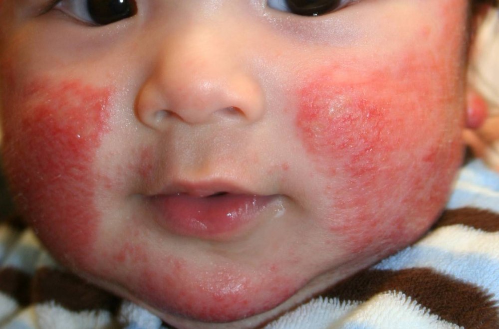 Контактный аллергический дерматит на лице фото